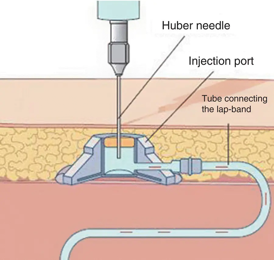 Figure 34 Pencil drawing of how to deflate port on LAGB Source Reproduced - фото 12