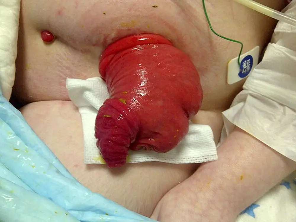 Figure 21 Stomal prolapse Source Photos courtesy Judith Stellar Stomal - фото 7