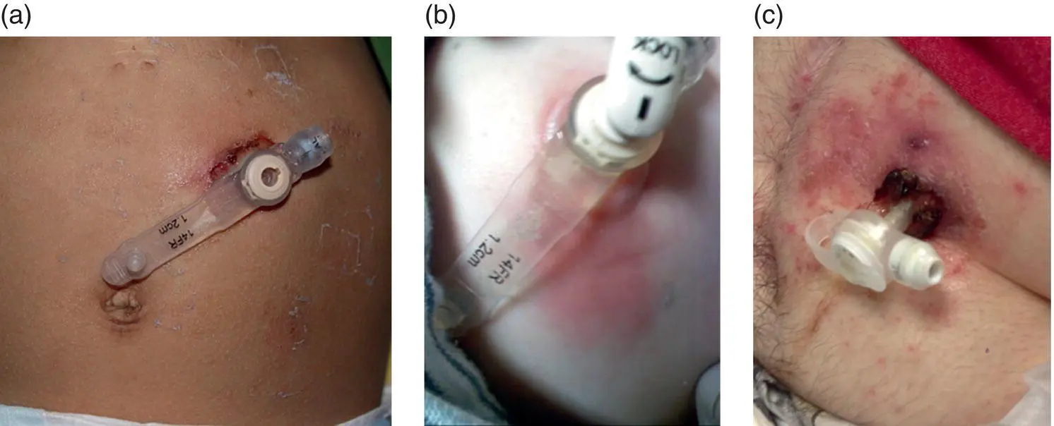 Figure 13 a Peristomal leakage notable for dried crusted skin without - фото 4