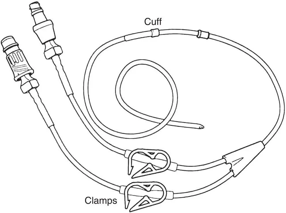 Figure 52 Schematic of externalized indwelling CVC Figure 53 Schematic of - фото 14