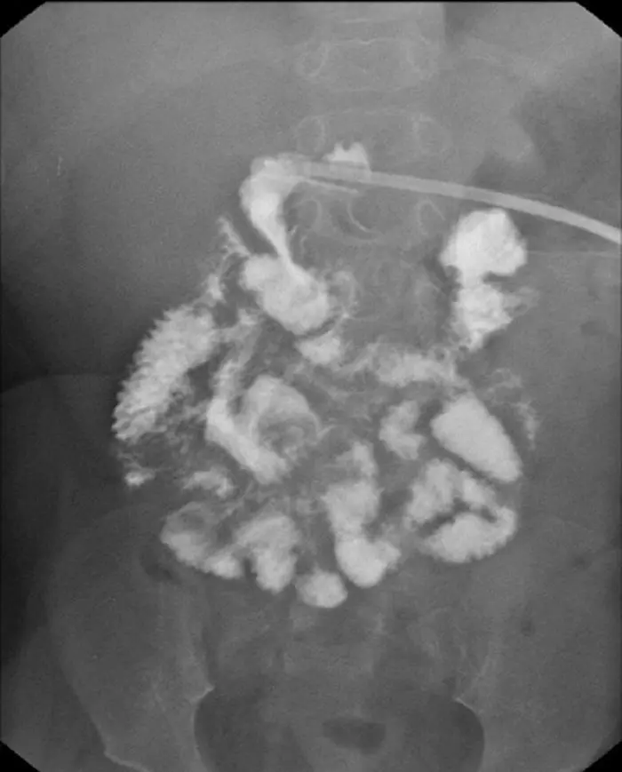 Figure 15 Radiograph of a Gtube dye study shows dye within the small - фото 6