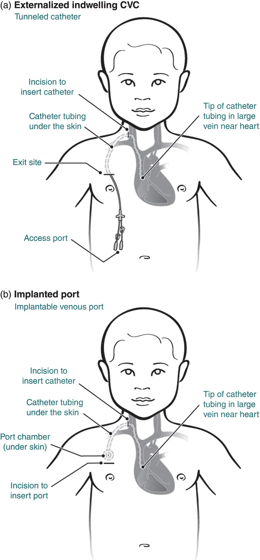 Figure 51 Schematic of CVC anatomy a Externalized indwelling CVC and b - фото 13