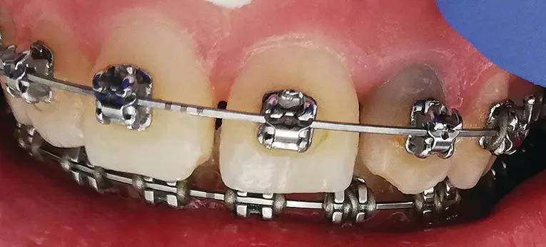 Figure 29 Discoloured maxillary left lateral incisor one year after a partial - фото 11