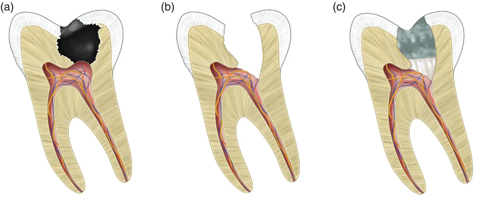 Figure 25 Partial pulpotomy a Deep carious lesion extending to the pulp - фото 7