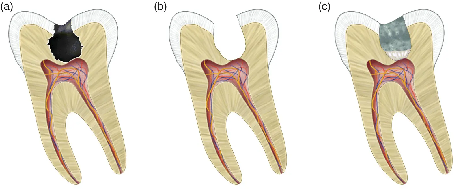 Figure 24 Direct pulp capping a Deep carious lesion extending to the pulp - фото 6