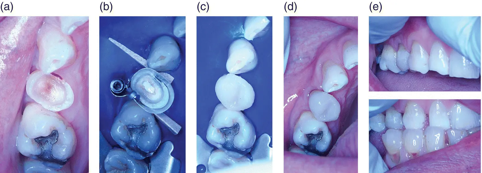 Figure 23 Intraoral photographs of an indirect pulpcapping procedure a - фото 5