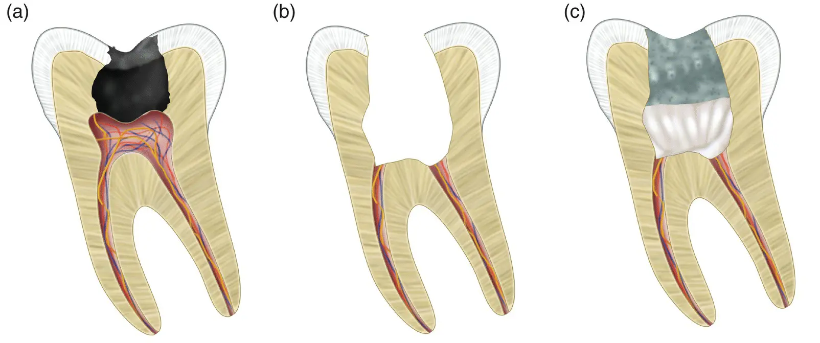 Figure 26 Full pulpotomy a Deep carious lesion extending to the pulp b - фото 8