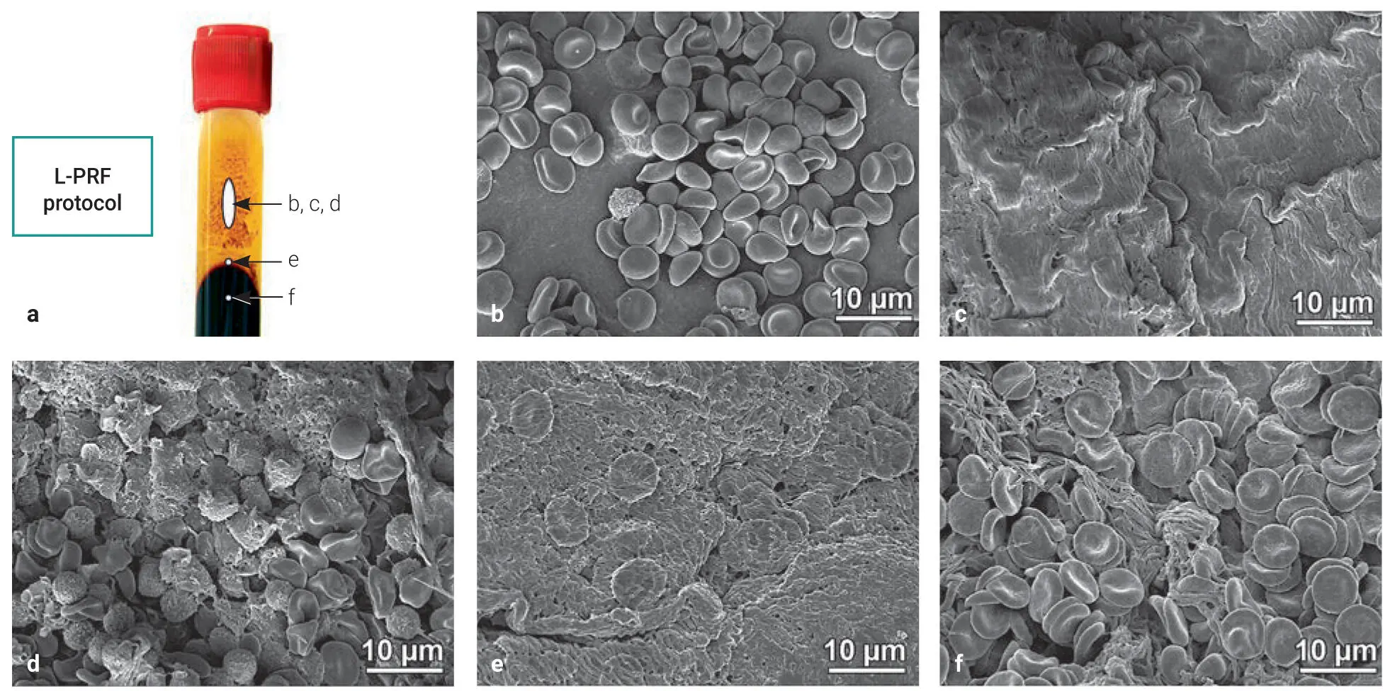 Fig 310SEM images of the distal surface of PRF clots prepared utilizing the - фото 76