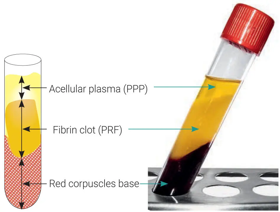 Fig 14Layers produced after centrifugation of whole blood A PRF clot forms in - фото 9