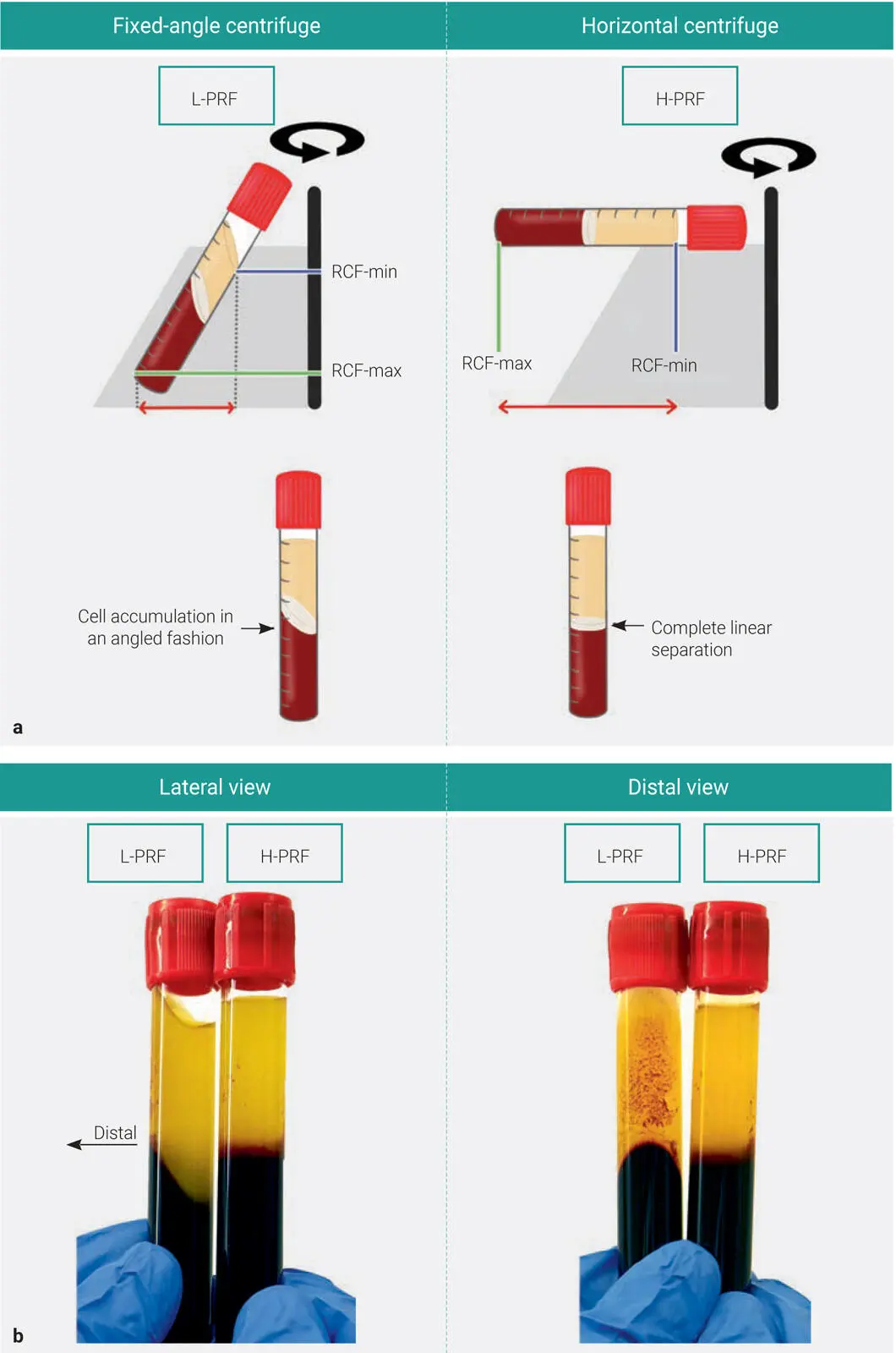 Fig 35 a Following centrifugation on fixedangle centrifuges blood layers - фото 69