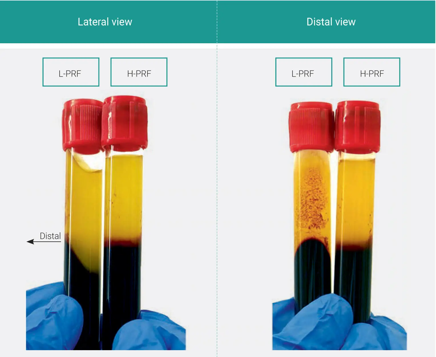 Fig 110Visual representation of layer separation following either LPRF or - фото 17