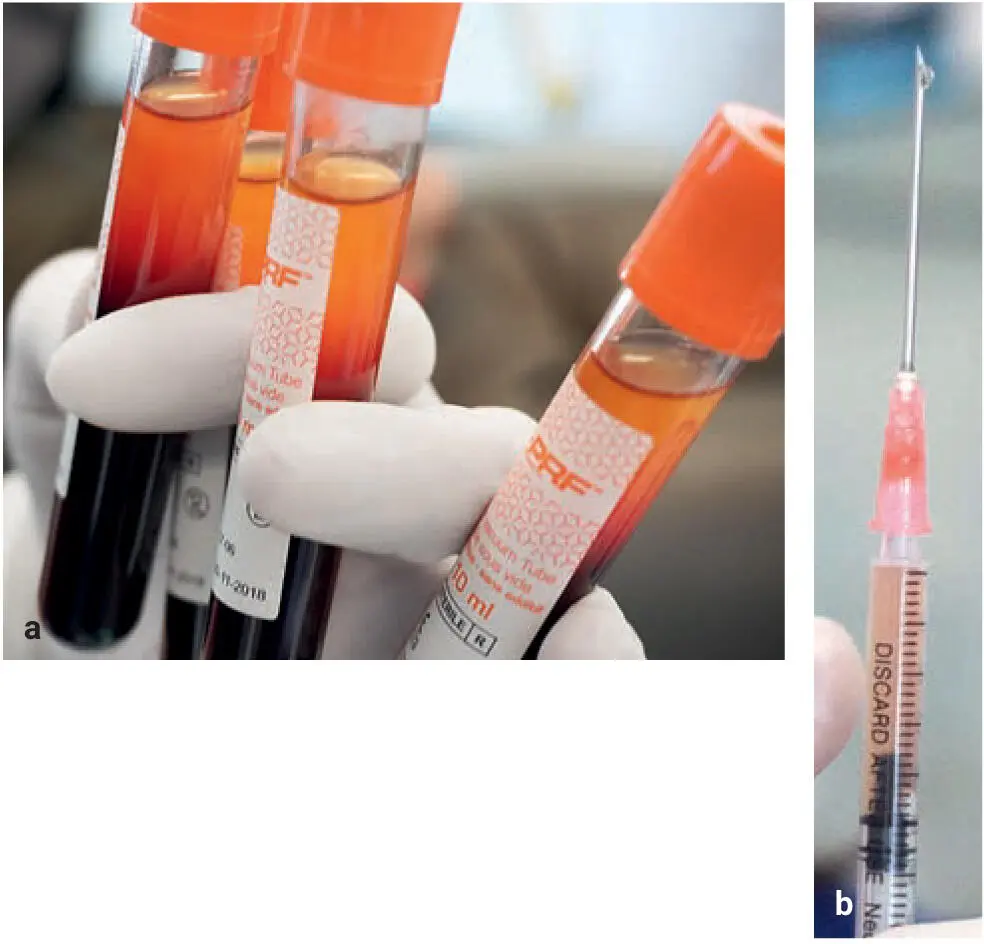 Fig 28 a Clinical photograph of liquidPRF Note that this protocol - фото 30