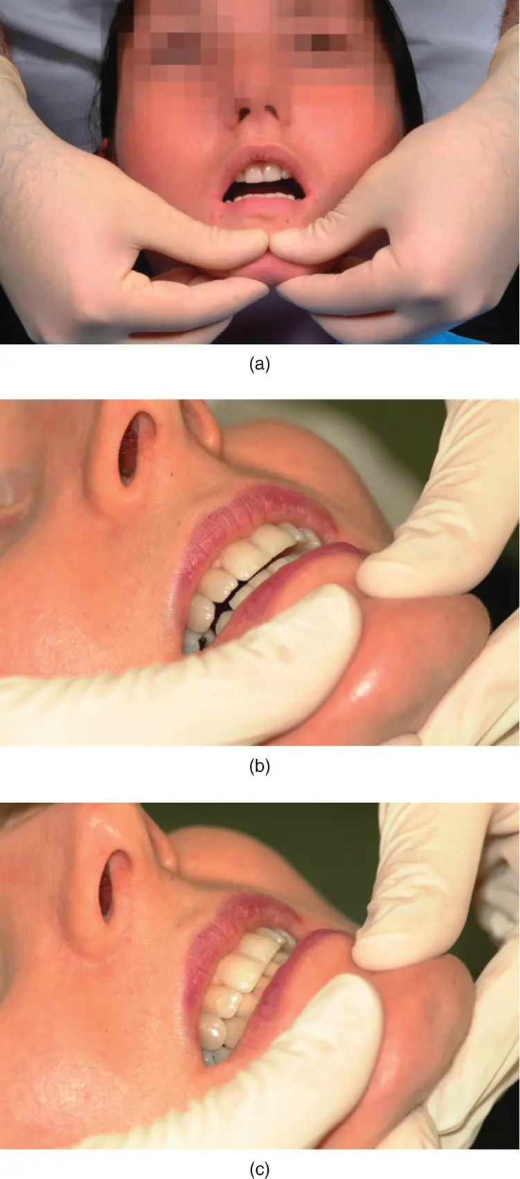 Figure 314a Centric relation CR recording b premature contact in CR - фото 61