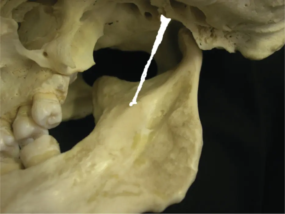 Temporomandibular Disorders - изображение 15