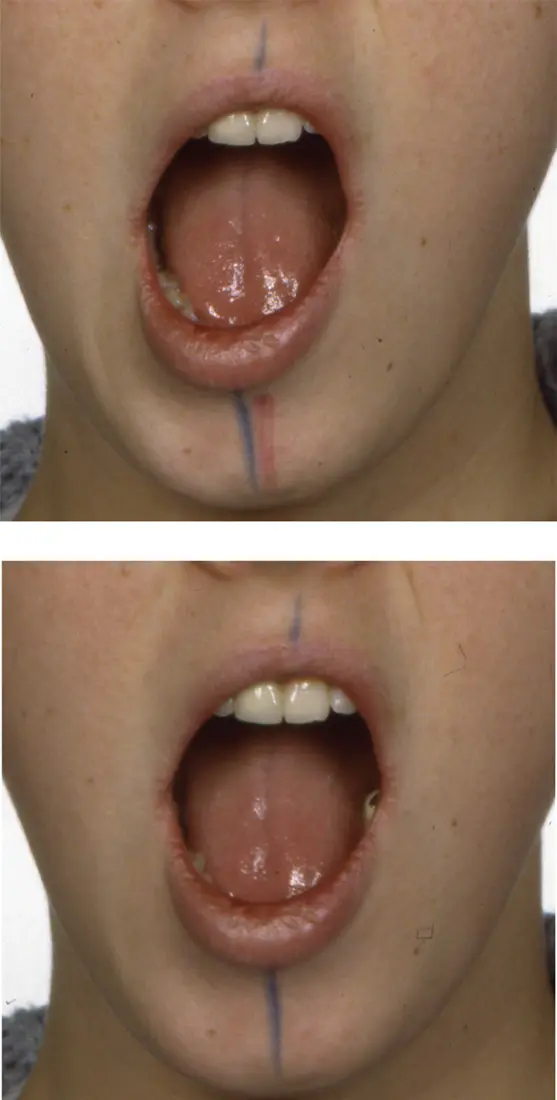 Figure 34a b Transient mandibular deviation during opening M Ziad - фото 40