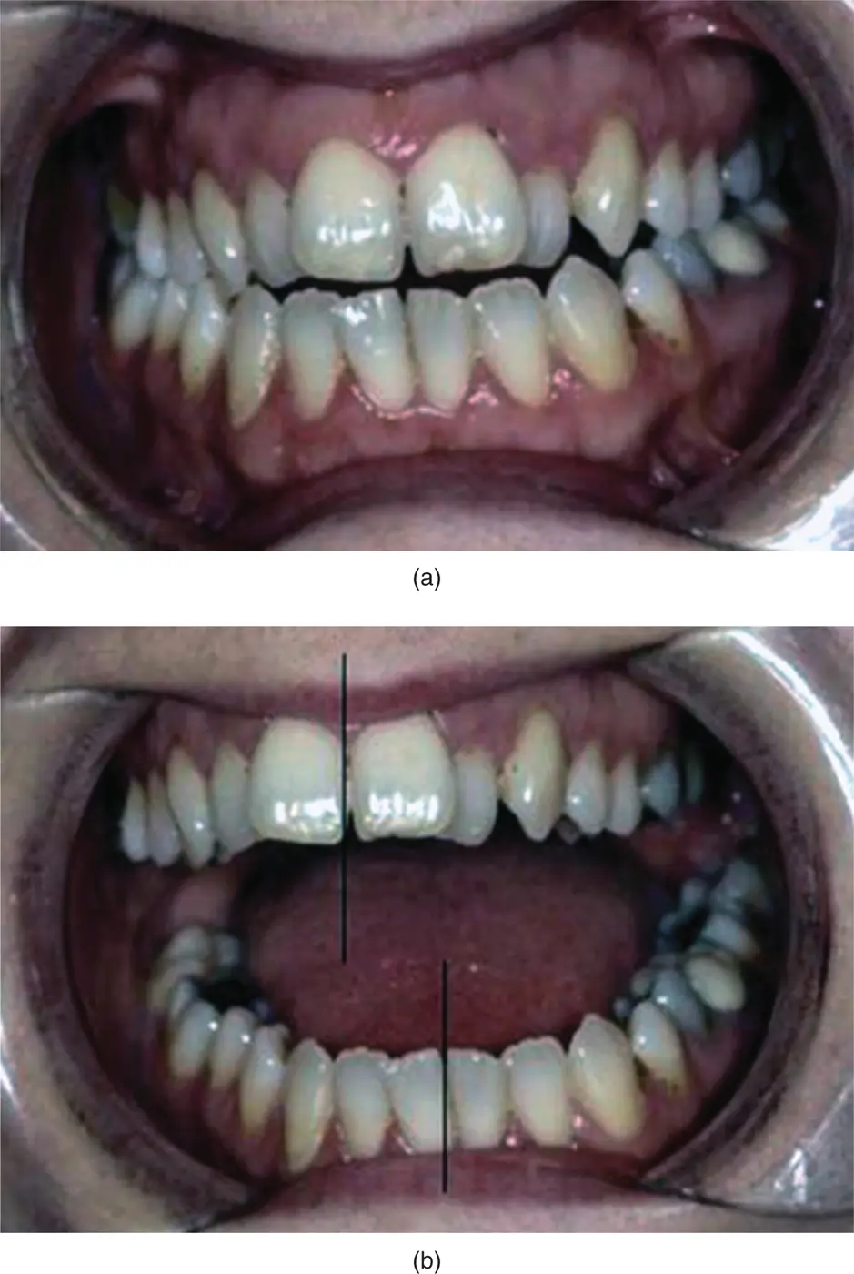 Figure 35Lasting deviation to the left a Mouth closed centre lines - фото 41