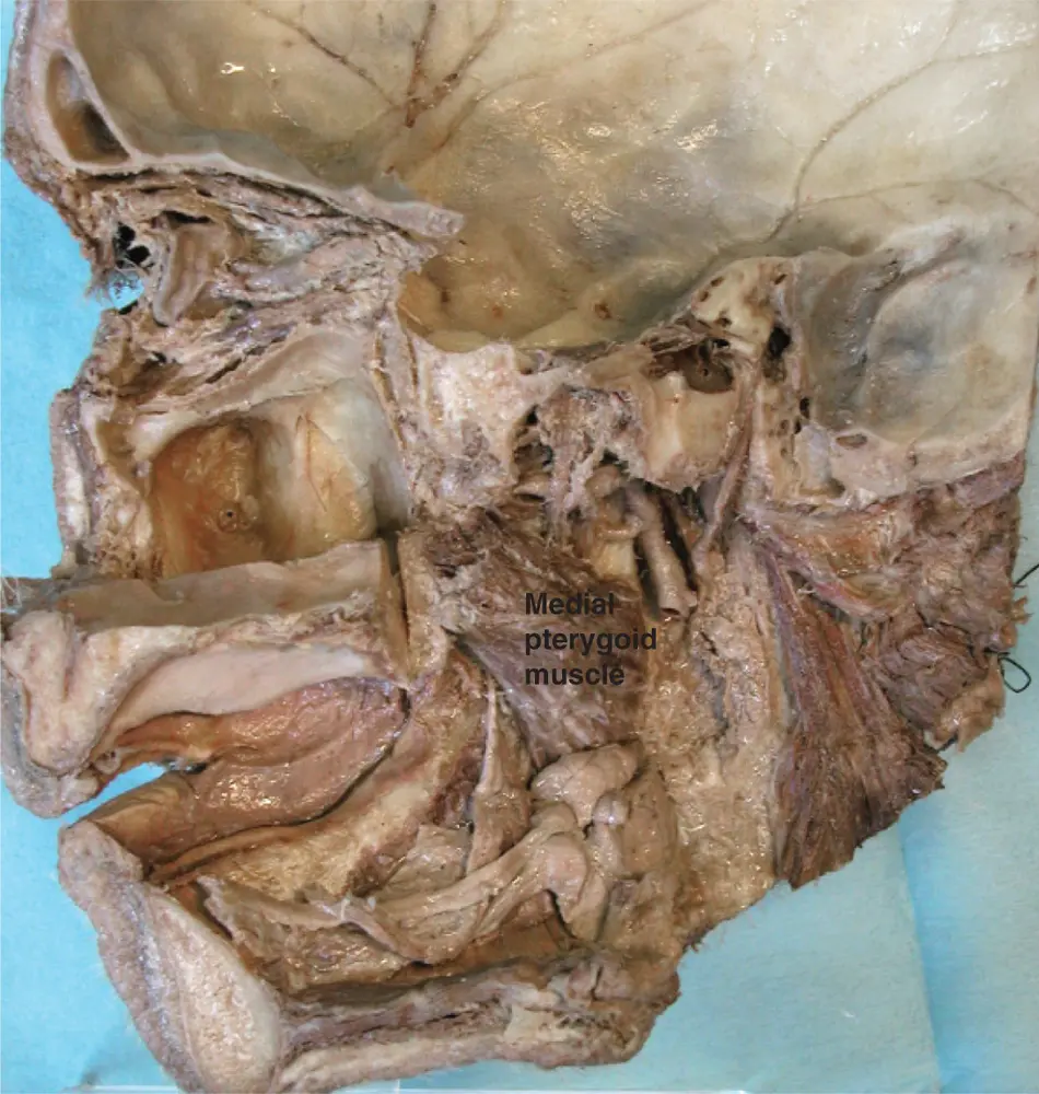 Figure 213Medial pterygoid showing ramus of mandible sectioned medial - фото 26