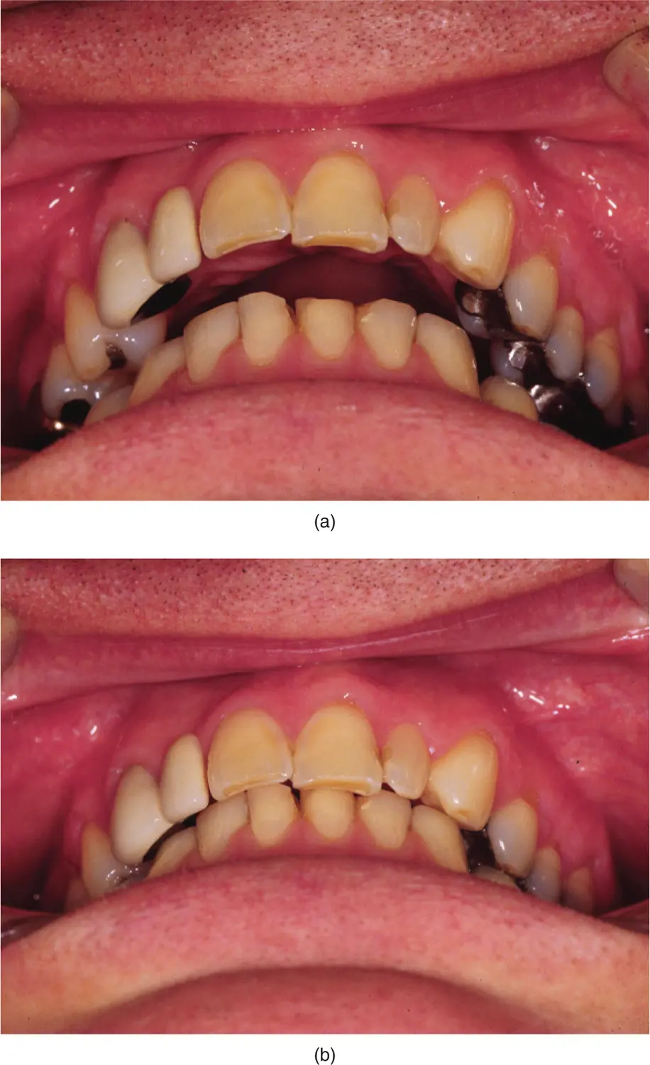 Figure 313The difference between a centric relation and b centric - фото 60