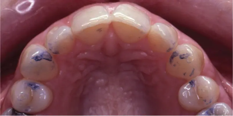 Figure 317Canine guidance M Ziad AlAni Robin JM Gray There can be - фото 65