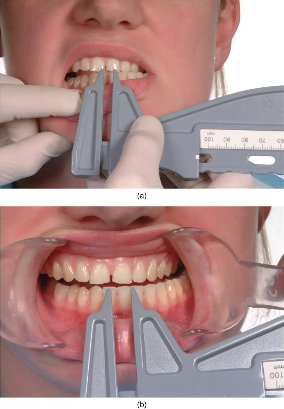 Figure 32Measurement of lateral jaw movement M Ziad AlAni Robin JM - фото 37