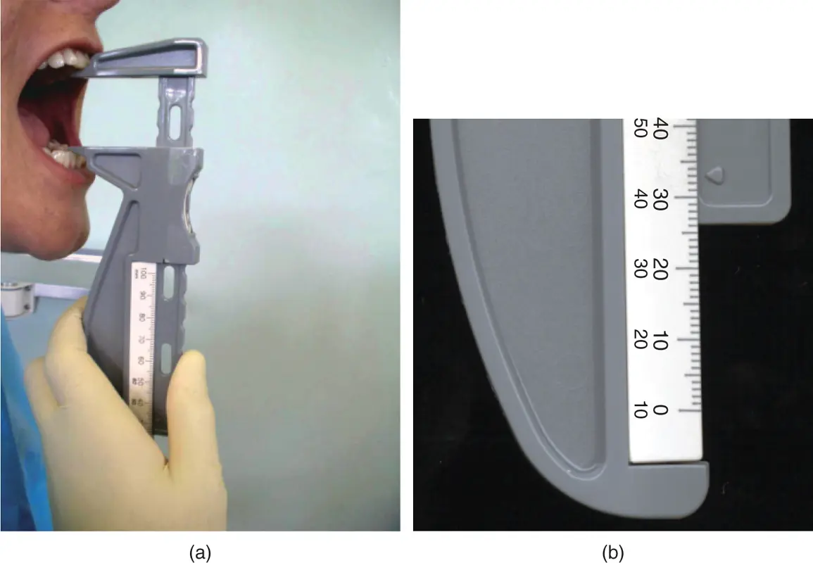 Figure 31Measurement of incisal opening M Ziad AlAni Robin JM Gray - фото 36