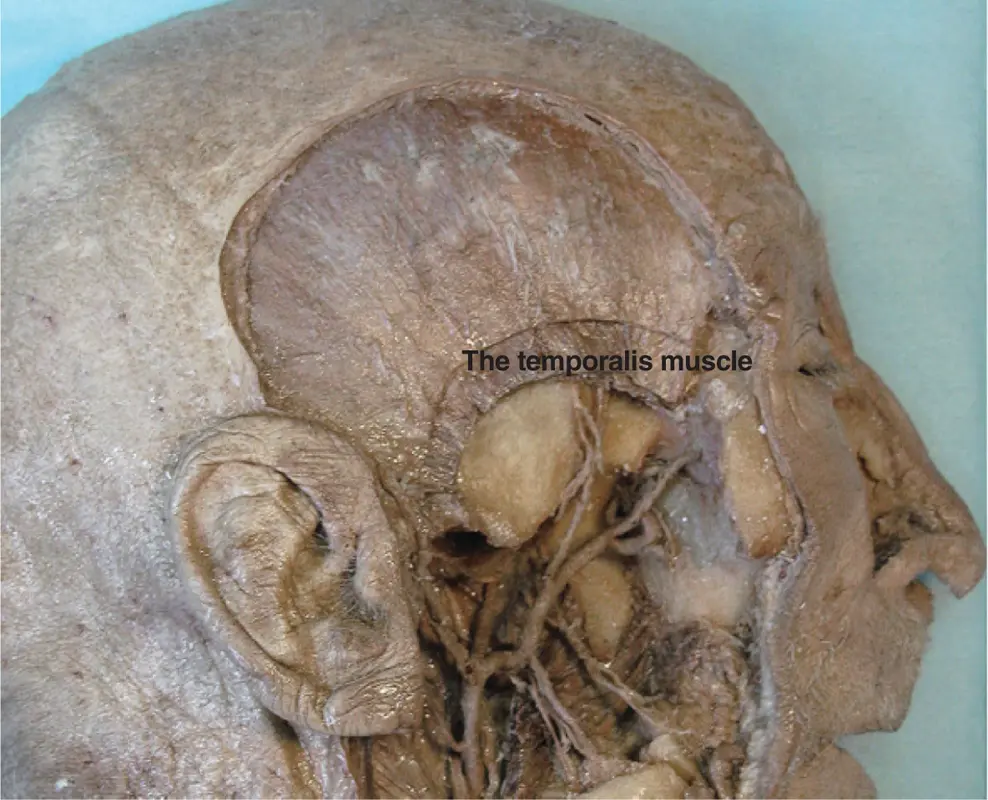 Figure 211The temporalis muscle Figure courtesy of Dr Paul Rea and Caroline - фото 24