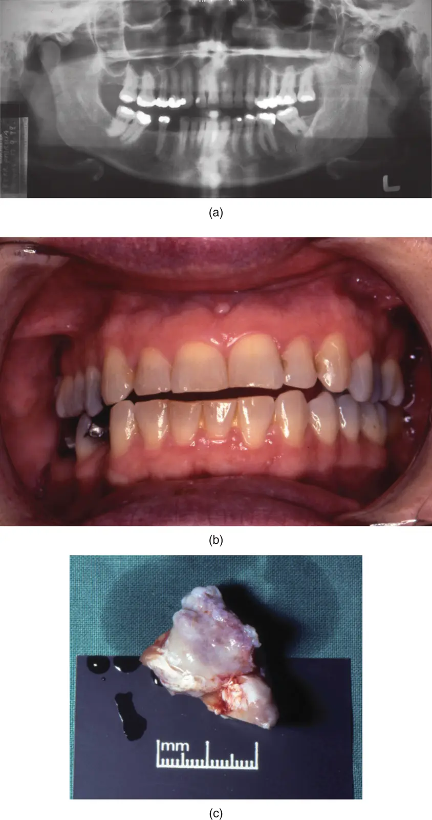 Figure 218a b Radiological mass anterior to left condyle and occlusal - фото 31