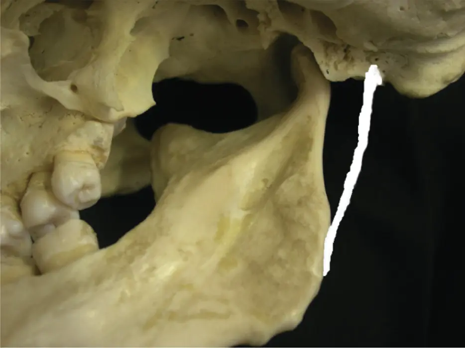 Figure 24The position of stylomandibular ligament M Ziad AlAni Robin JM - фото 14