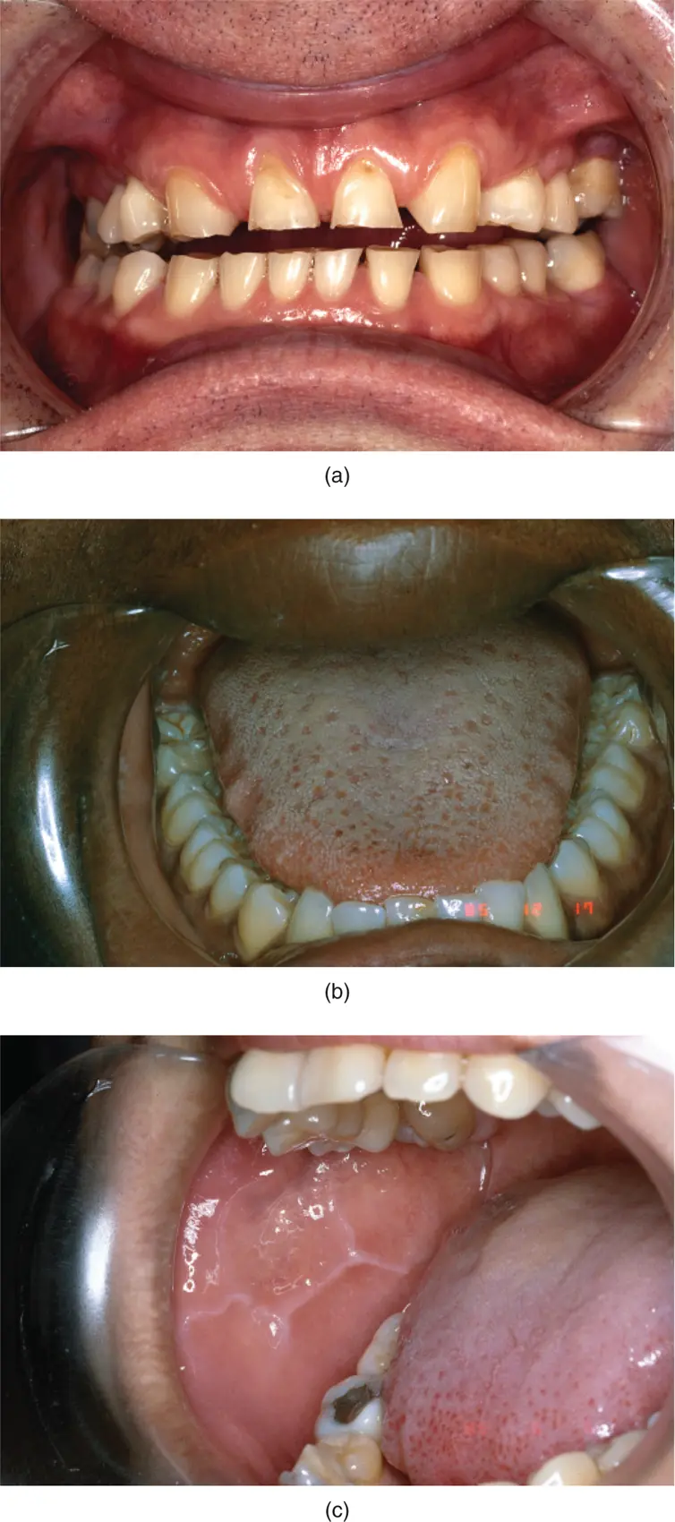Figure 312a Attrition b tongue scalloping and c cheek ridging seen in - фото 56