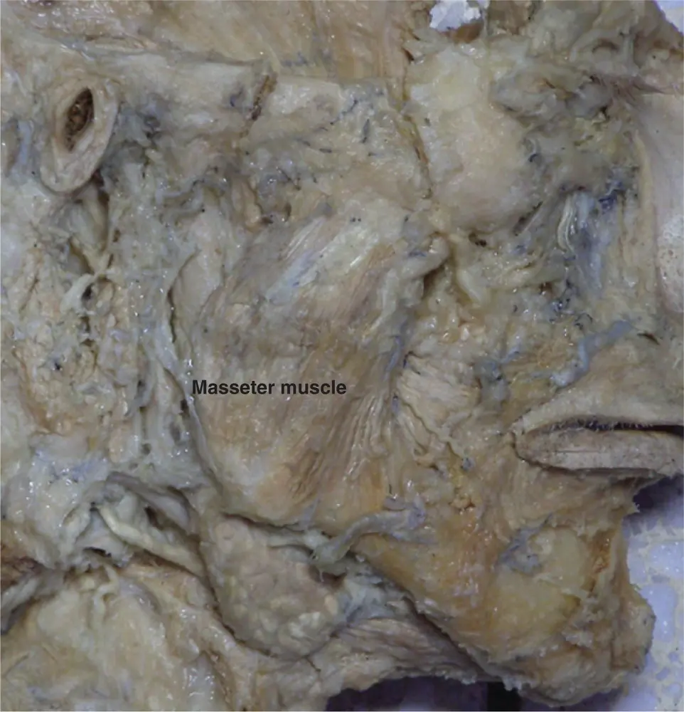 Figure 210The masseter muscle Figure courtesy of Dr Paul Rea and Caroline - фото 23