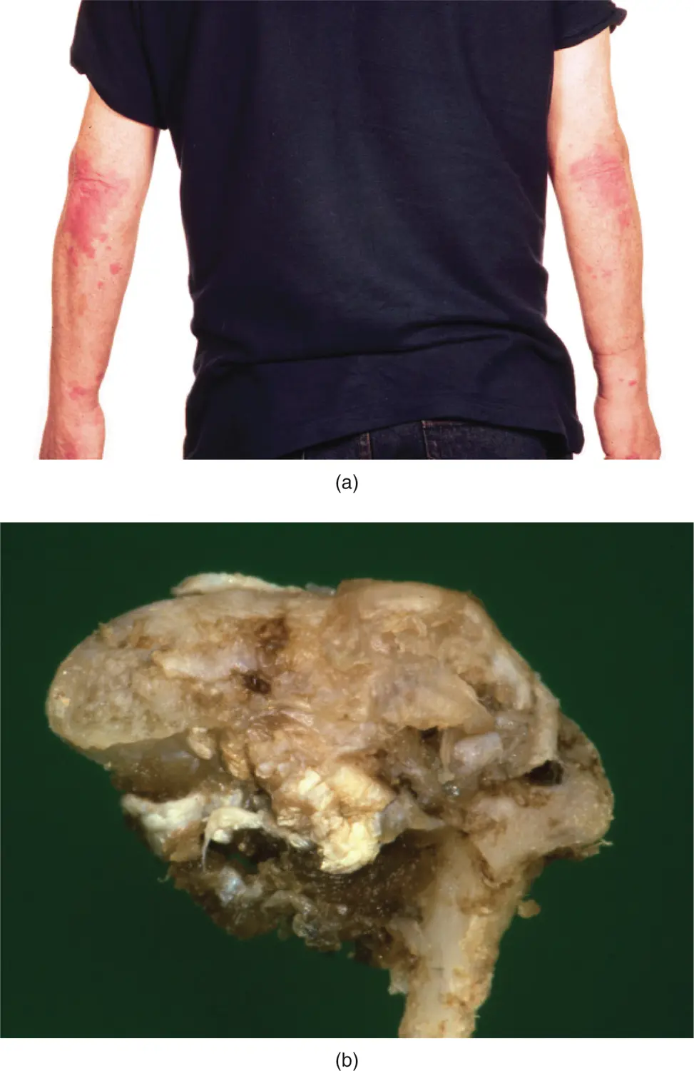 Figure 219a Psoriasis skin condition b excised condyle of a patient with - фото 32