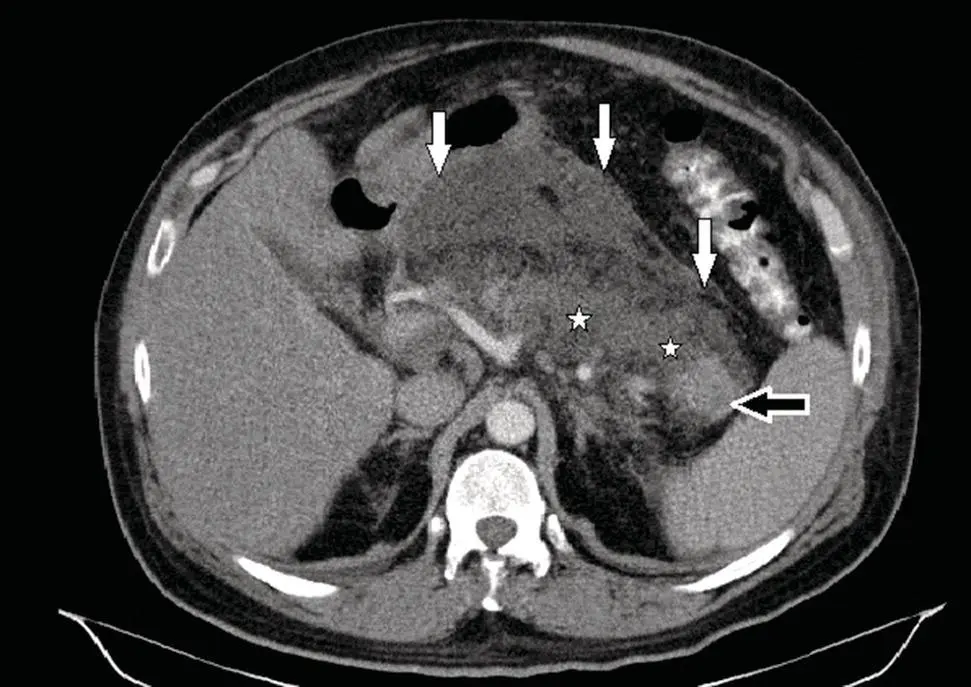 Figure 33 CECT showing acute necrotizing pancreatitis with an acute necrotic - фото 5