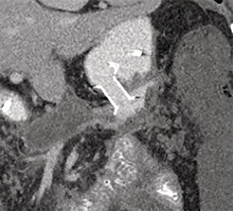 Figure 172 CT scan showing LAMS in situ Source courtesy of Muhammad F - фото 26