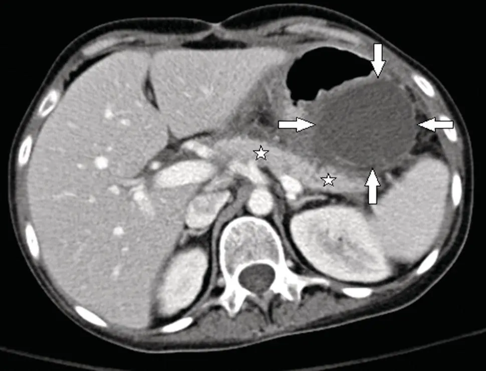 Figure 32 CECT showing a pancreatic pseudocyst more than four weeks after an - фото 4