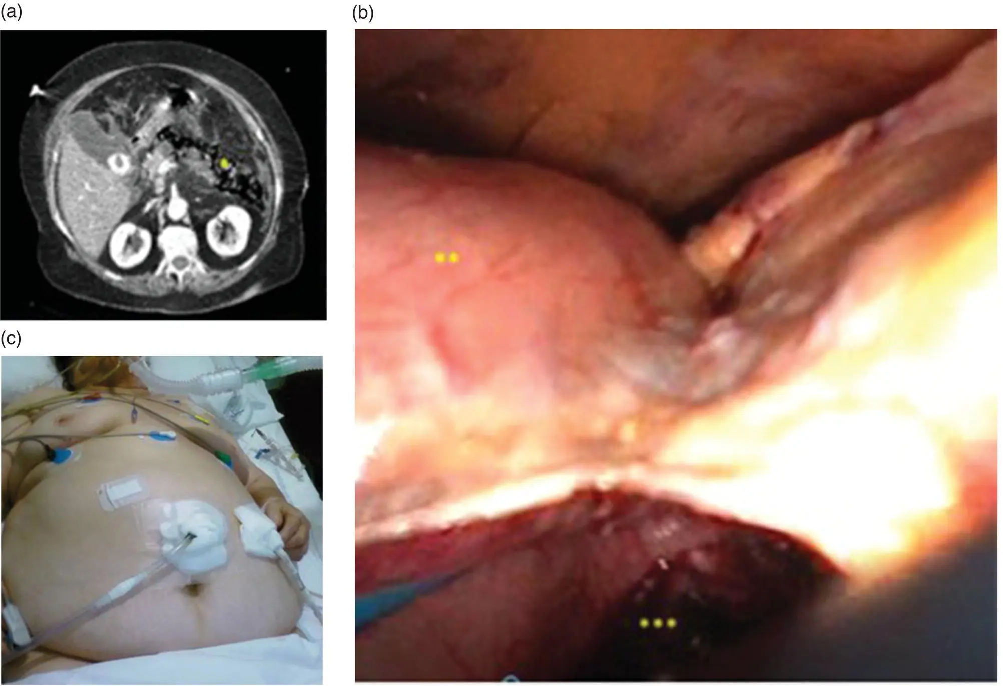 Figure 153 Laparoscopic transperitoneal approach a Location of the necrosis - фото 23