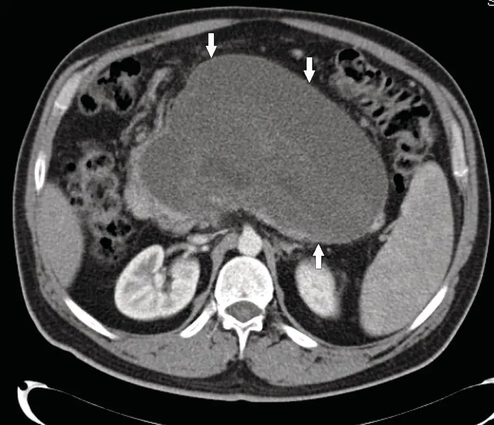 Figure 34 CECT showing walledoff necrosis WON more than four weeks after an - фото 6