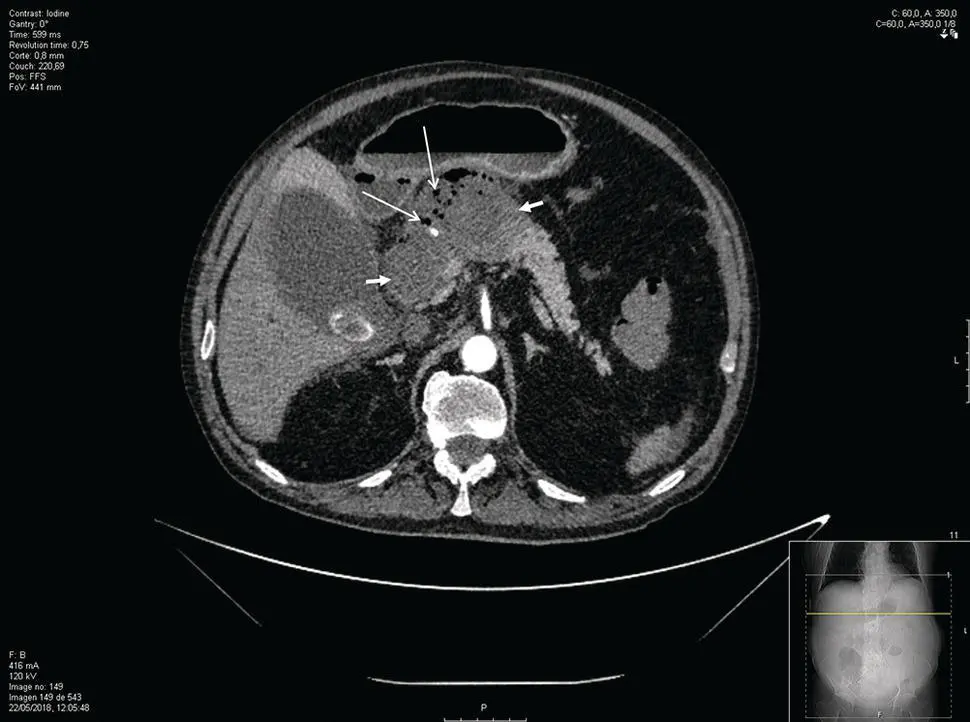 Figure 141 CT scan of a patient with walledoff necrosis short arrows - фото 18