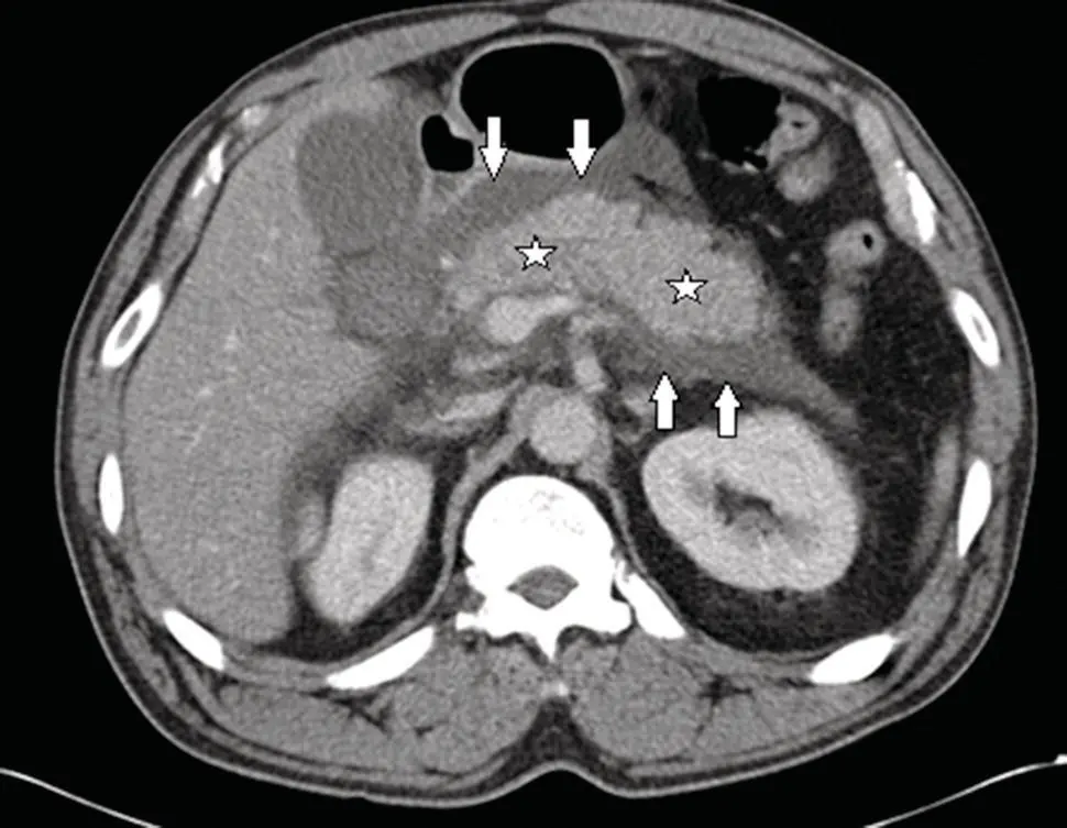 Figure 31 CECT showing acute interstitial edematous pancreatitis with acute - фото 3