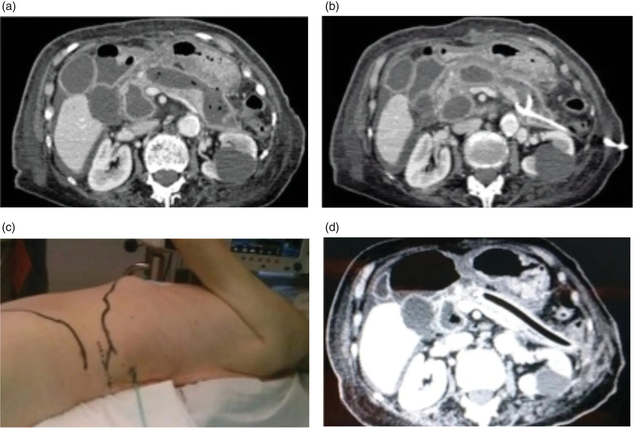 Figure 152 a Infected pancreatic necrosis by abdominal tomography b - фото 22