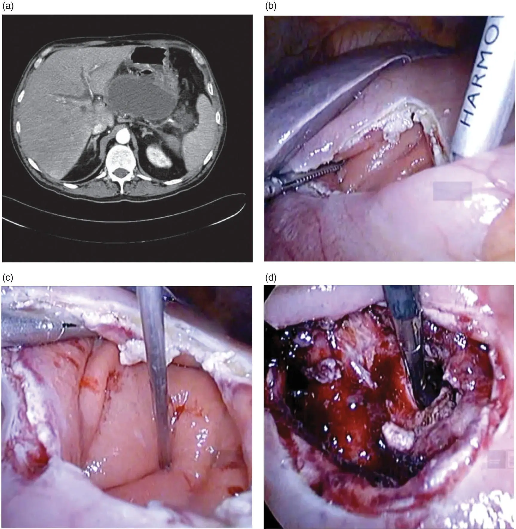 Figure 154 Laparoscopic transgastric necrosectomy a CT scan diagnoses a - фото 24