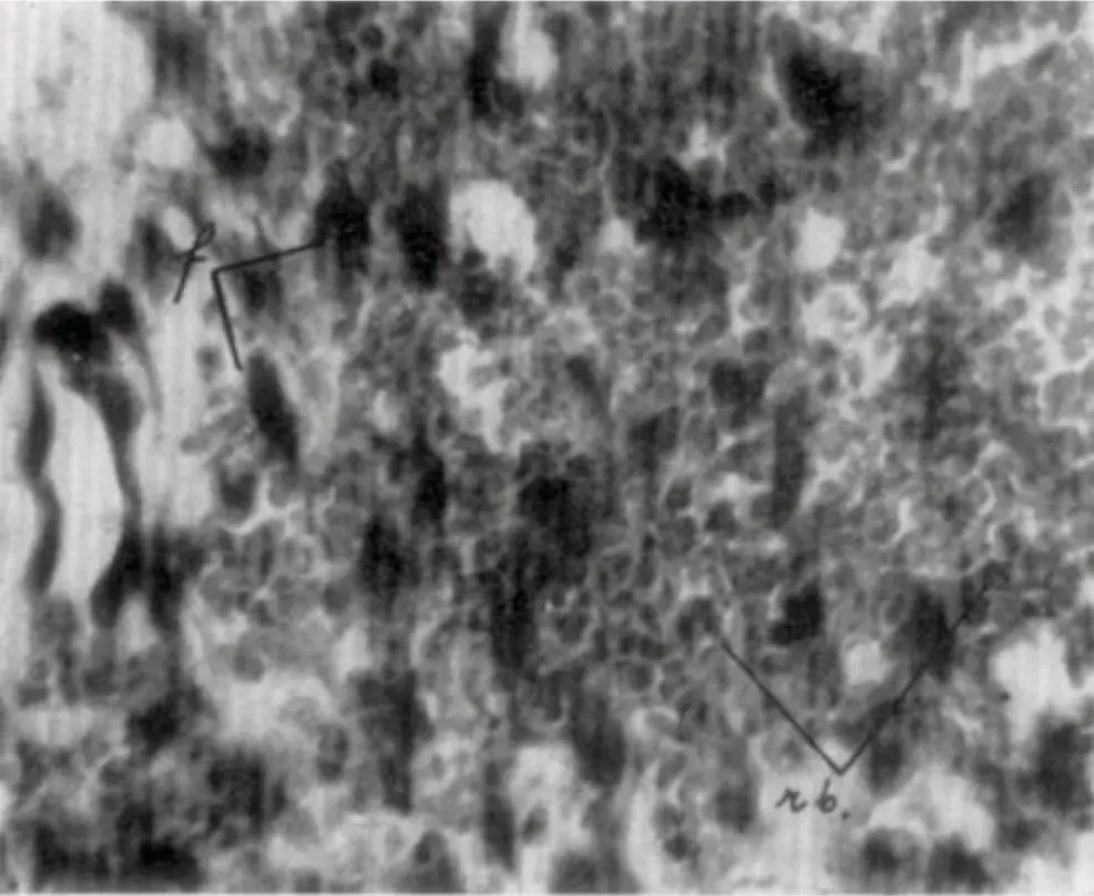 Figure 213 Higher magnification image of hemorrhage as portrayed in Oppenheim - фото 35