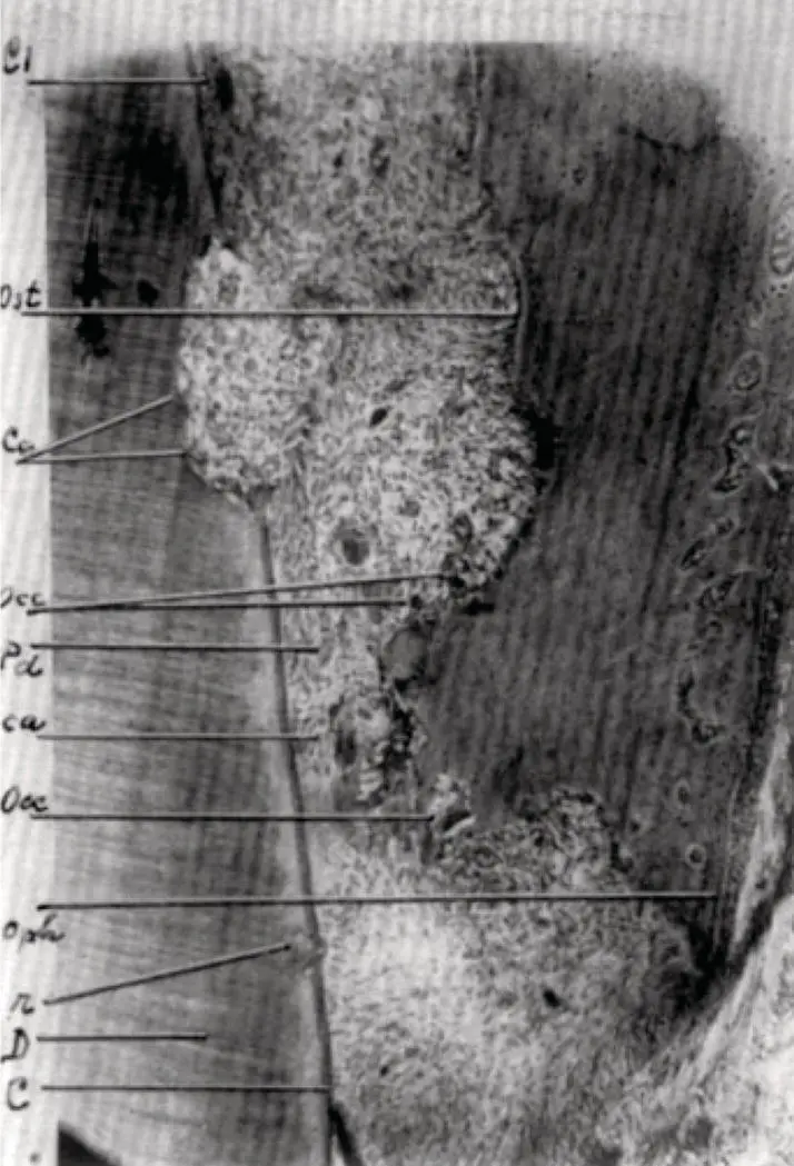 Figure 214 Hyalinization reaction as portrayed in Oppenheim 1944 The - фото 36