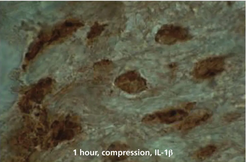Figure 122 Staining for IL1β in PDL and alveolar bone surface cells after 1 - фото 23