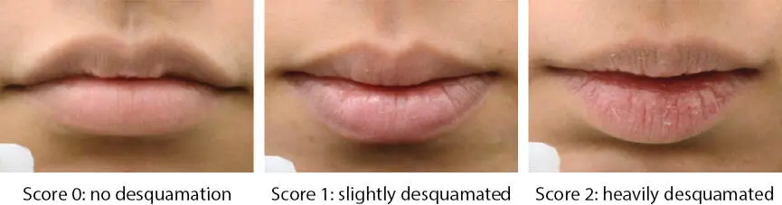 Figure 15 Lip roughness score 40 Thus far this book chapter has provided - фото 13