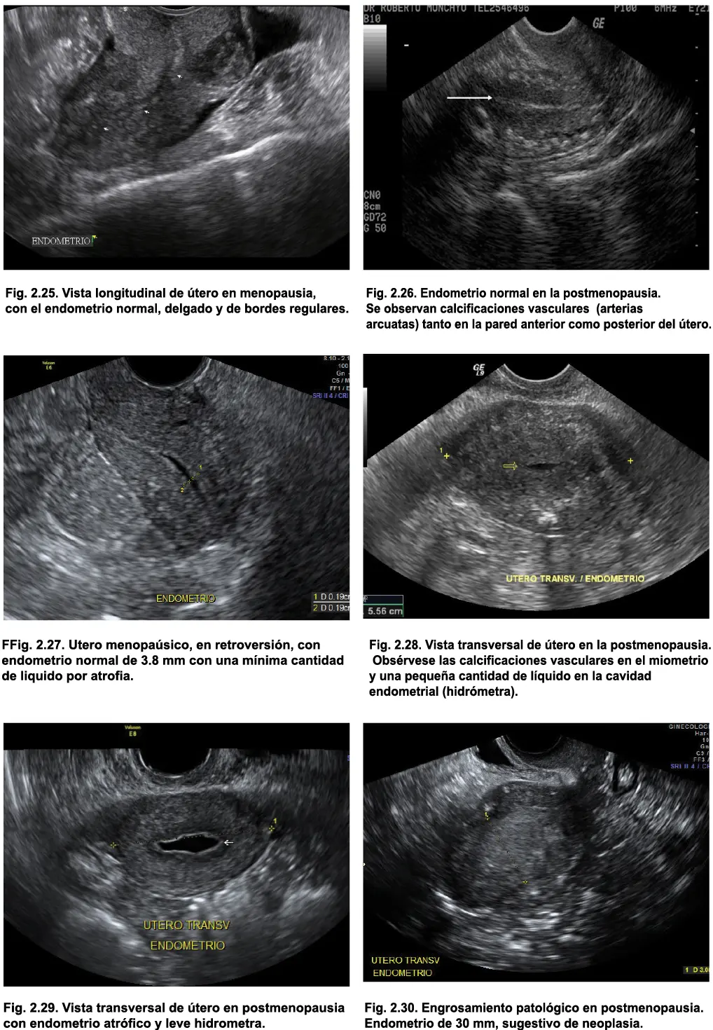 Tabla 21 Grosor normal máximo endometrial por ecografía Fase menstrual 4 - фото 19