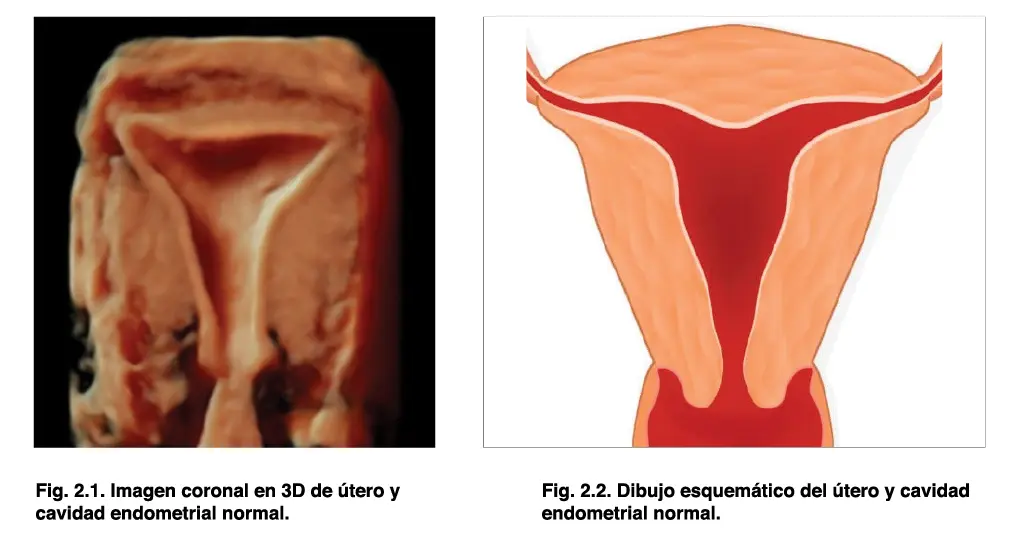 La ecografía transvaginal es el método ideal para valorar el endometrio y medir - фото 12