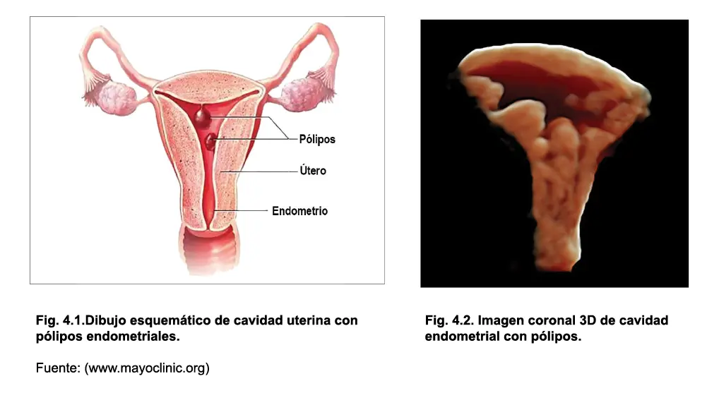 La prevalencia mundial de pólipos endometriales está entre 8 y 10 - фото 25