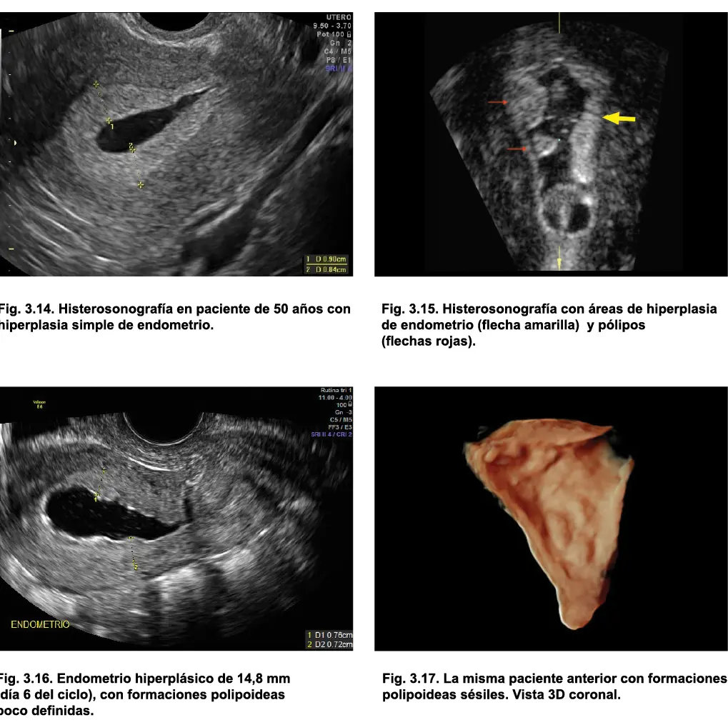 Bibliografía Barakat RR Tamoxifen and endometrial neoplasia Clin Obstet - фото 24