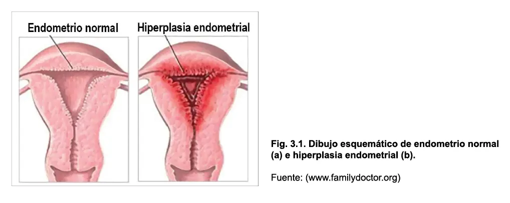 La hiperplasia endometrial se define como una proliferación de glándulas de - фото 20