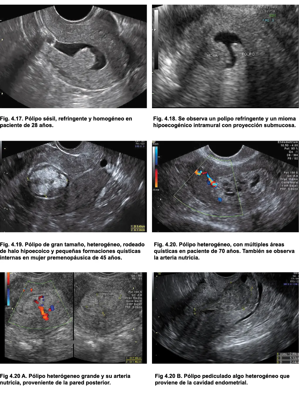 6 Bordes regulares Los pólipos endometriales tienen por lo general bordes - фото 30